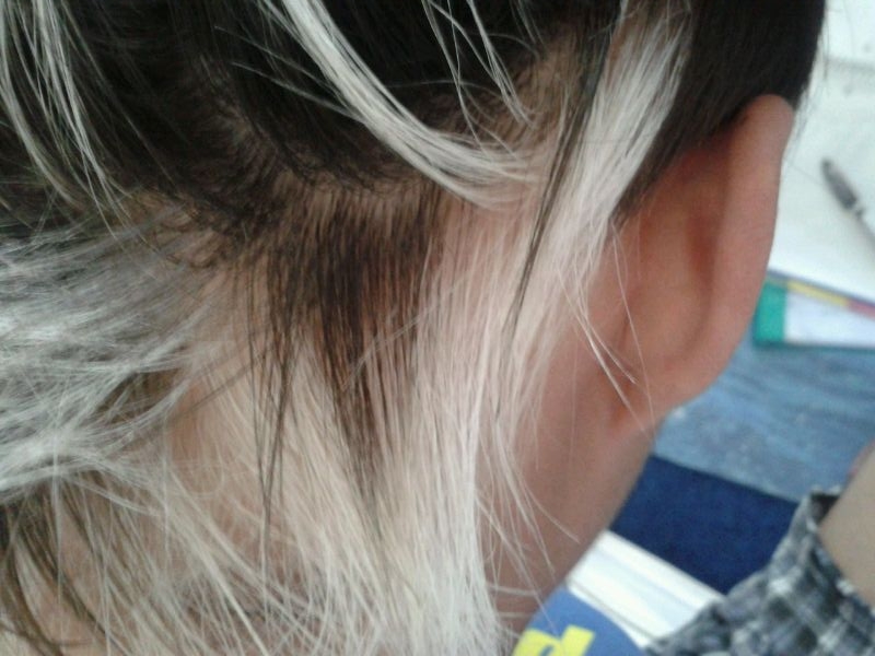 Haaruitval, kale plekken, grijs wit haar, bij jongeren